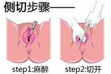 顺产侧切手术全过程以及术后护理的正确方法（附图）